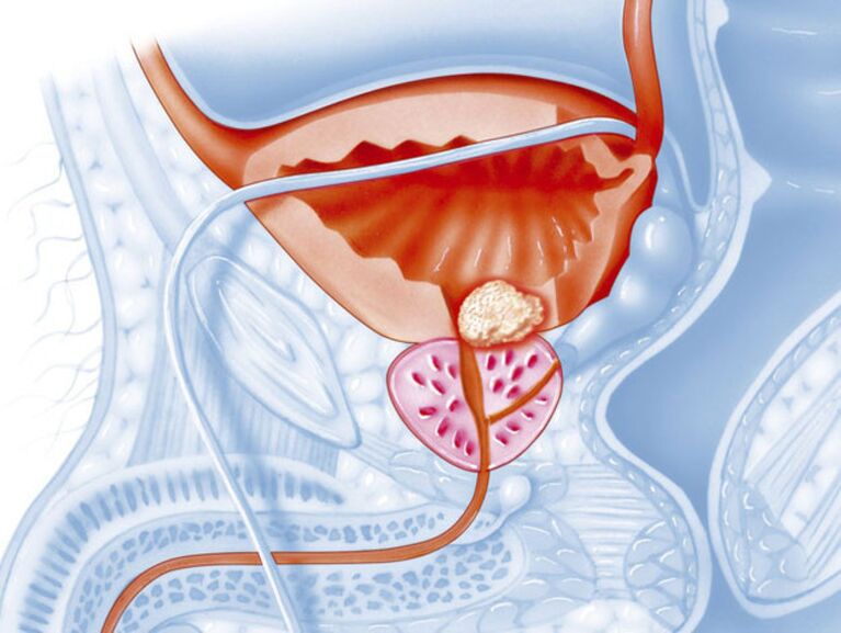 Symptome einer chronischen Prostatitis
