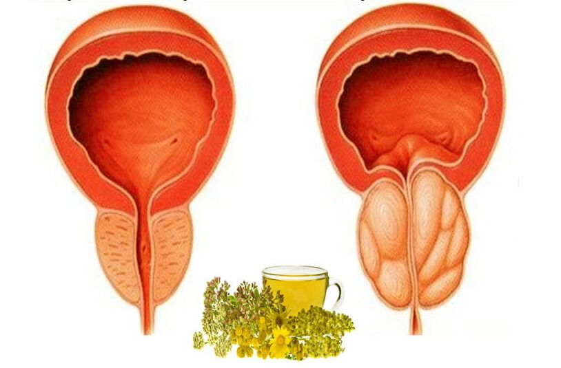 Gesunde und schmerzhafte Prostata